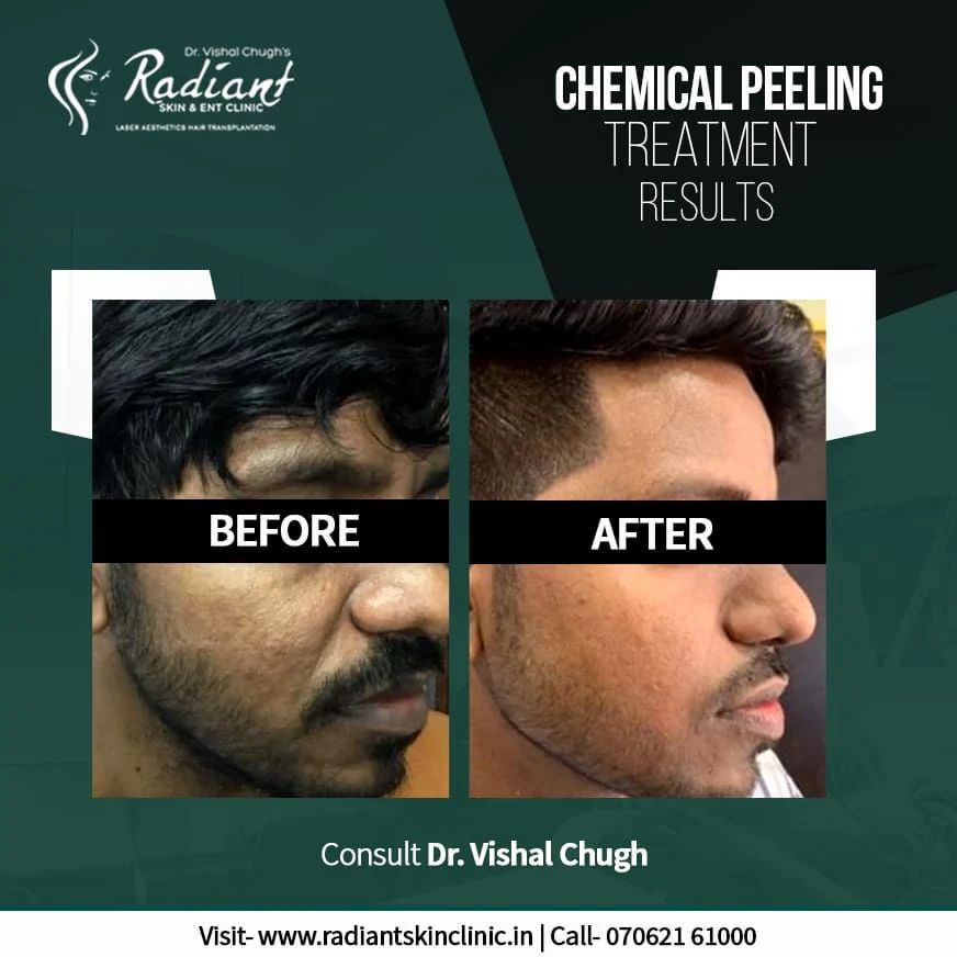 Best Chemical Peeling Treatment in Jaipur