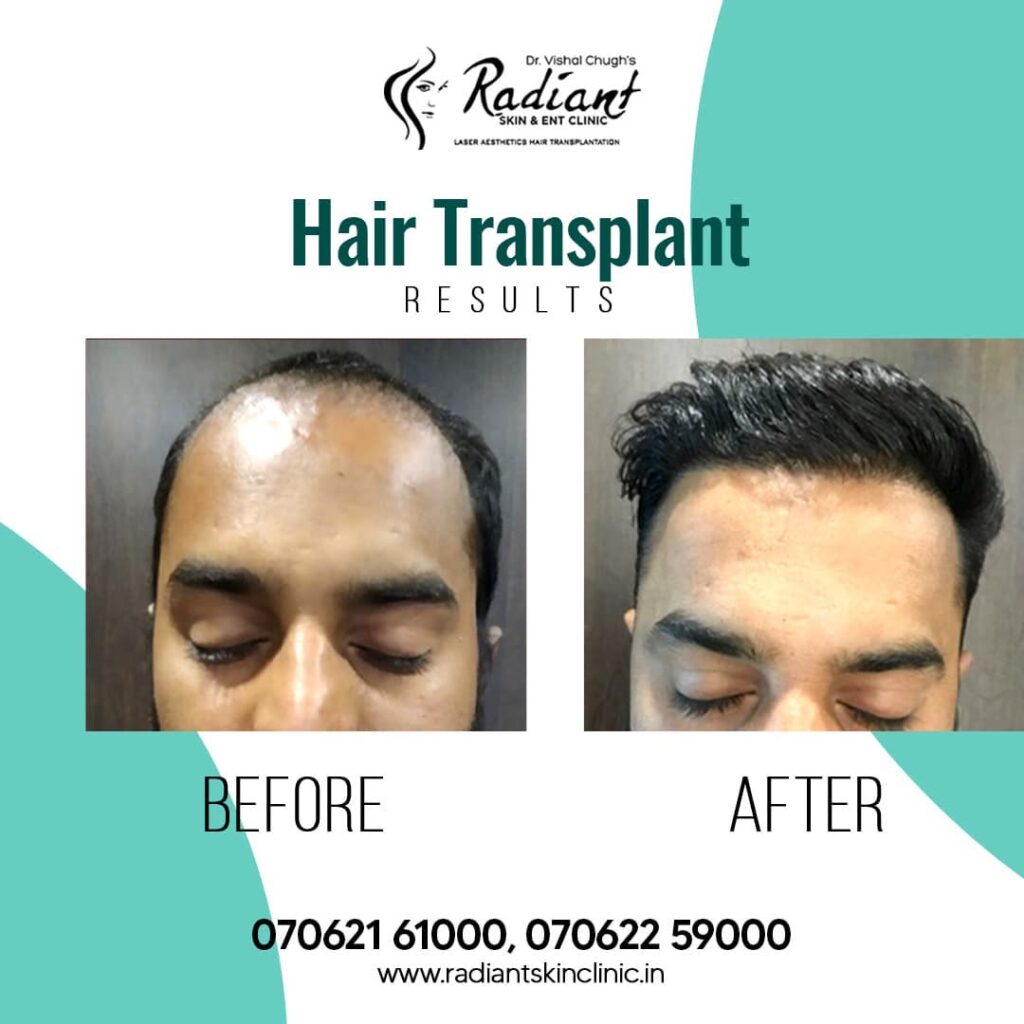 Hair Transplant Treatment in Jaipur