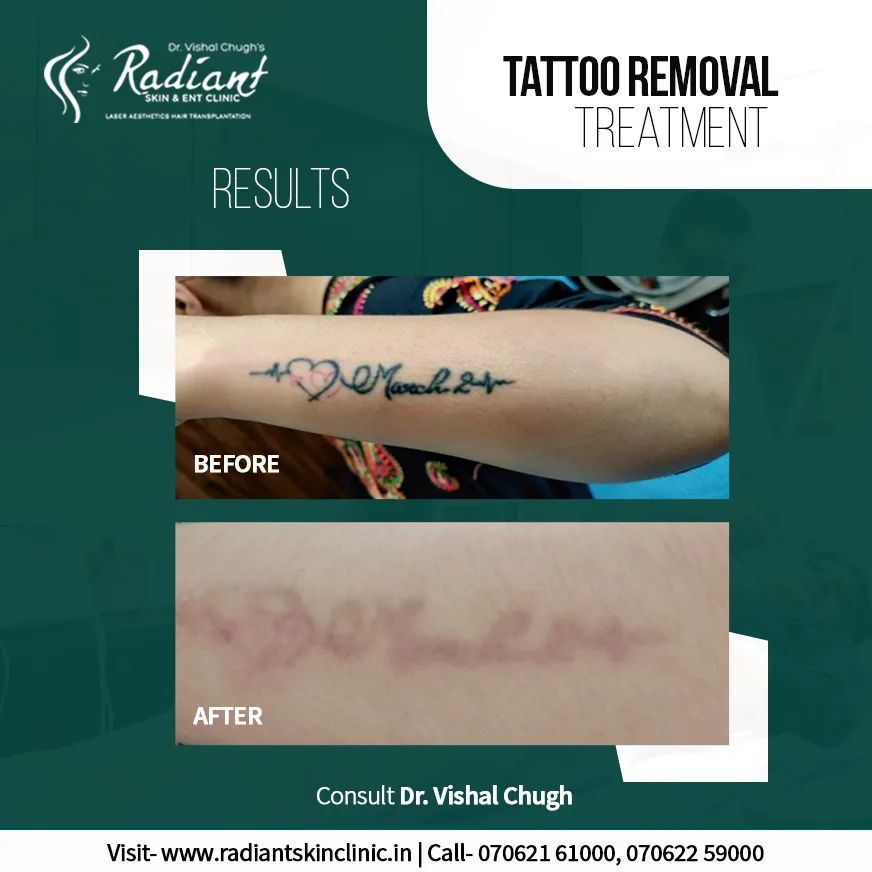 Best Tattoo Removal Treatment in Jaipur