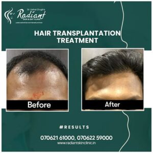 Hair Transplant Doctor in Jaipur