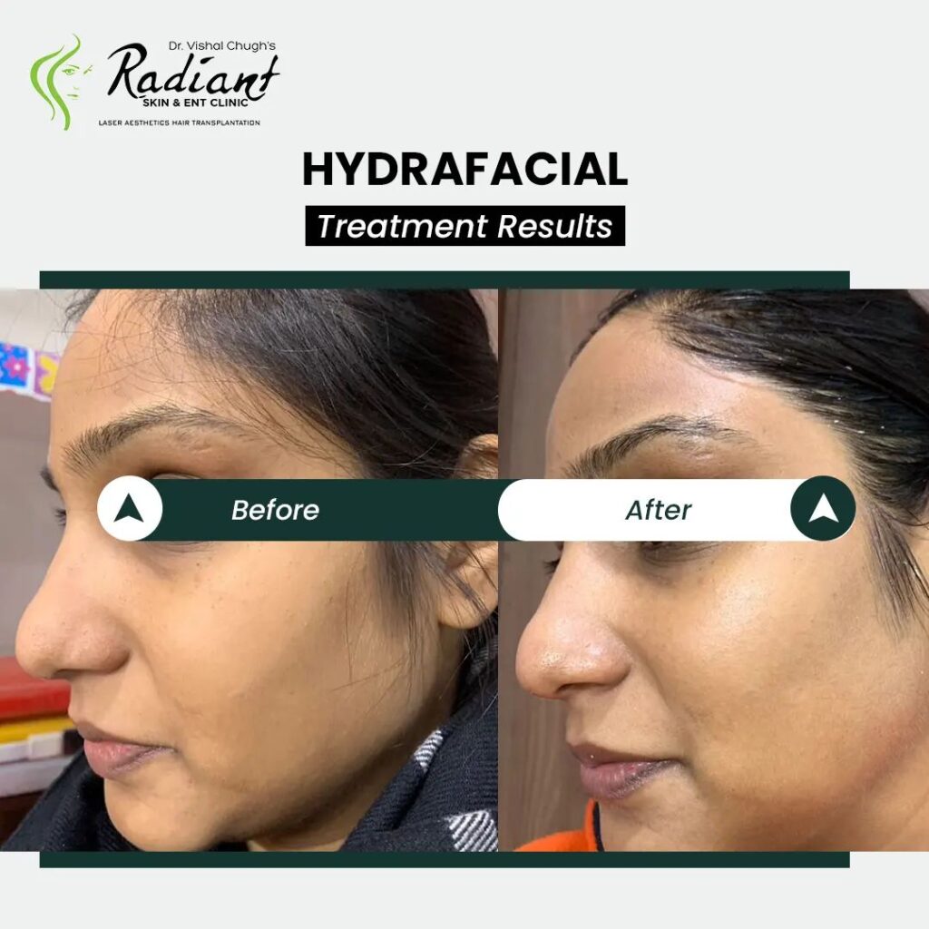 Hydrafacial Treatment in Jaipur