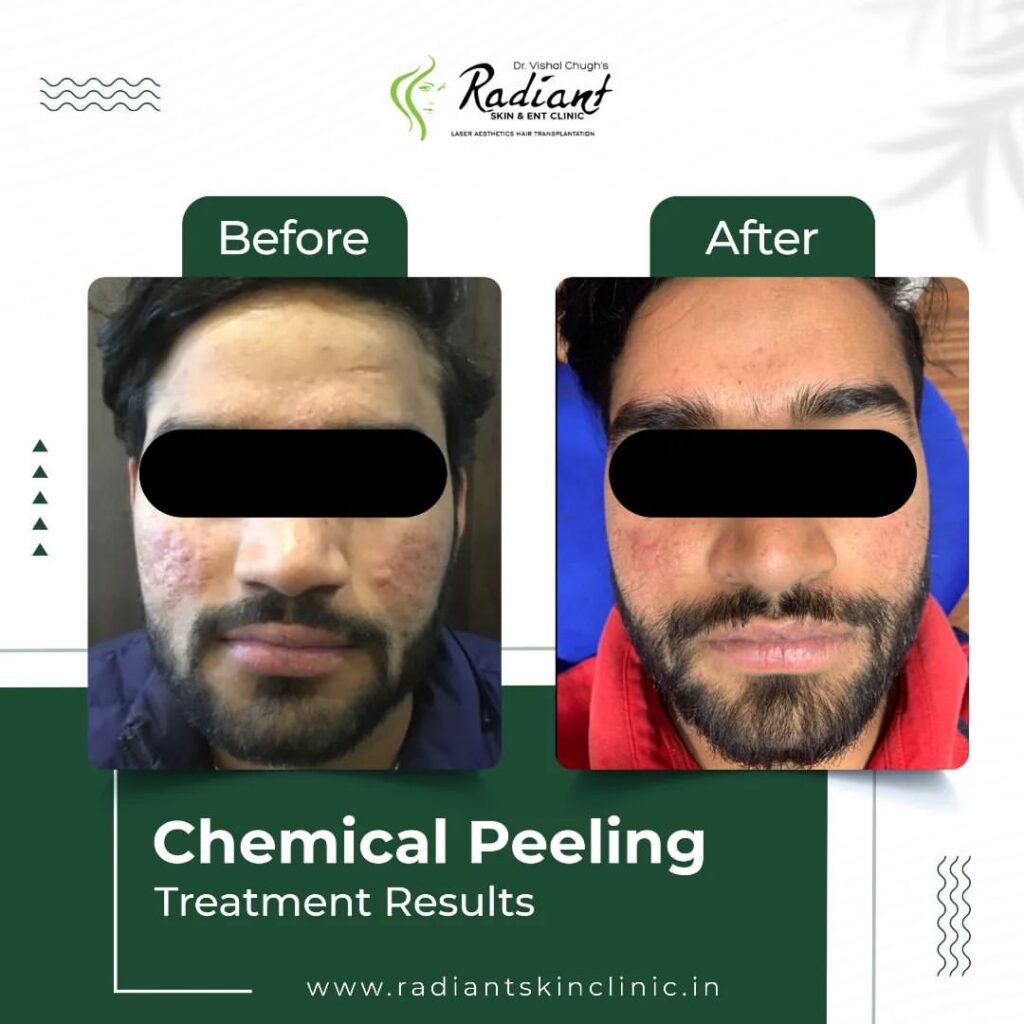 Best Chemical Peeling Treatment in Jaipur