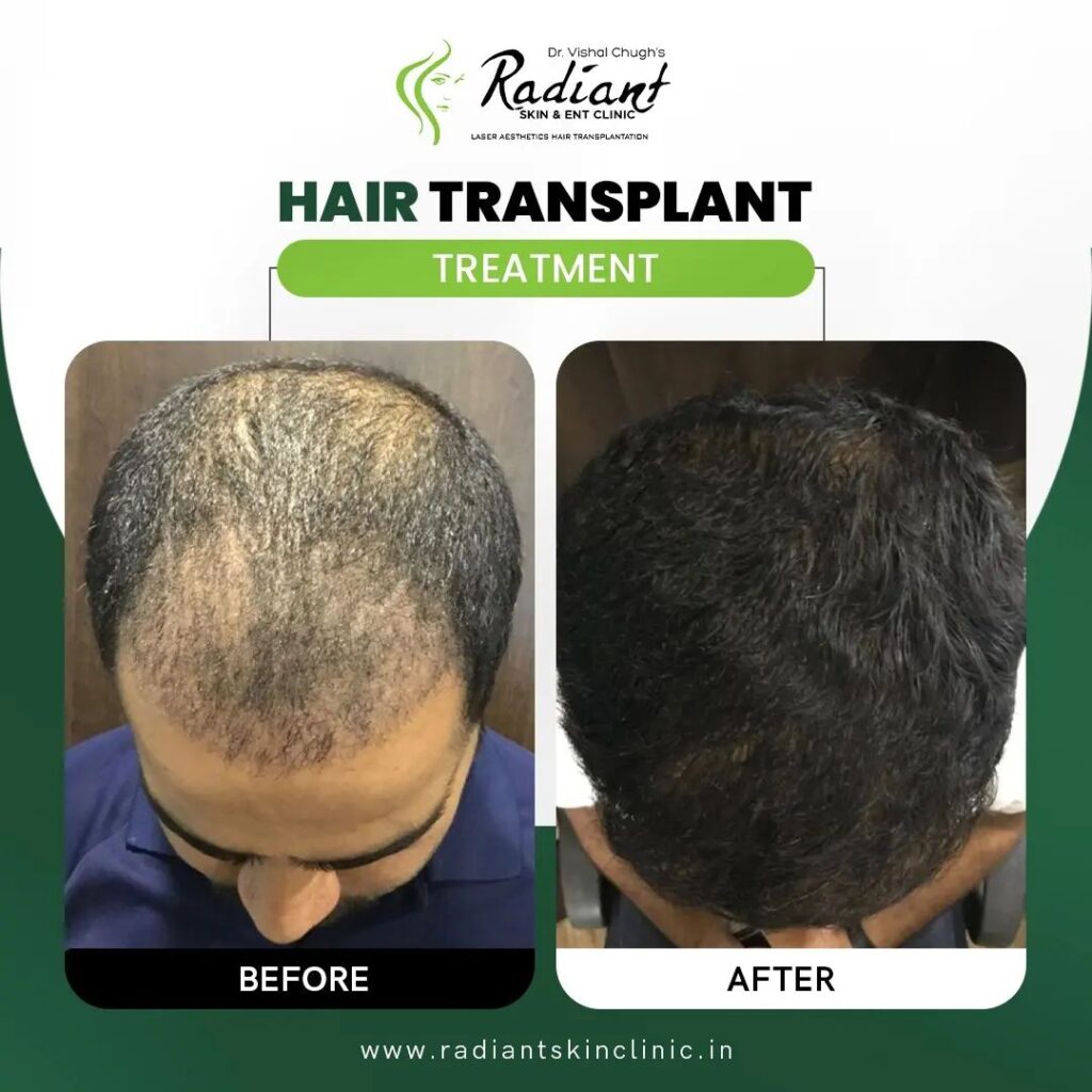 Best Hair Transplant Clinic in Jaipur