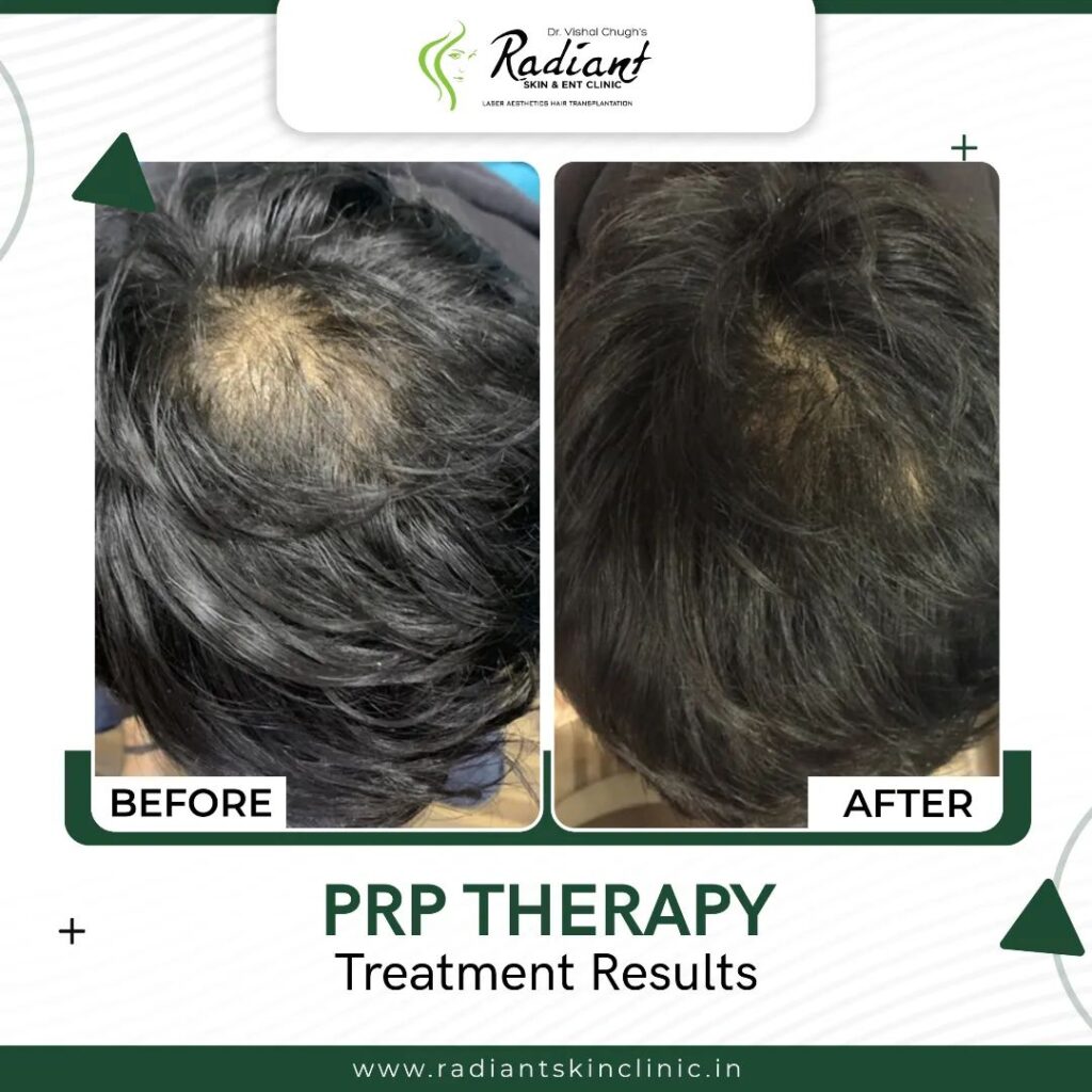 Best PRP Therapy Treatment in Jaipur