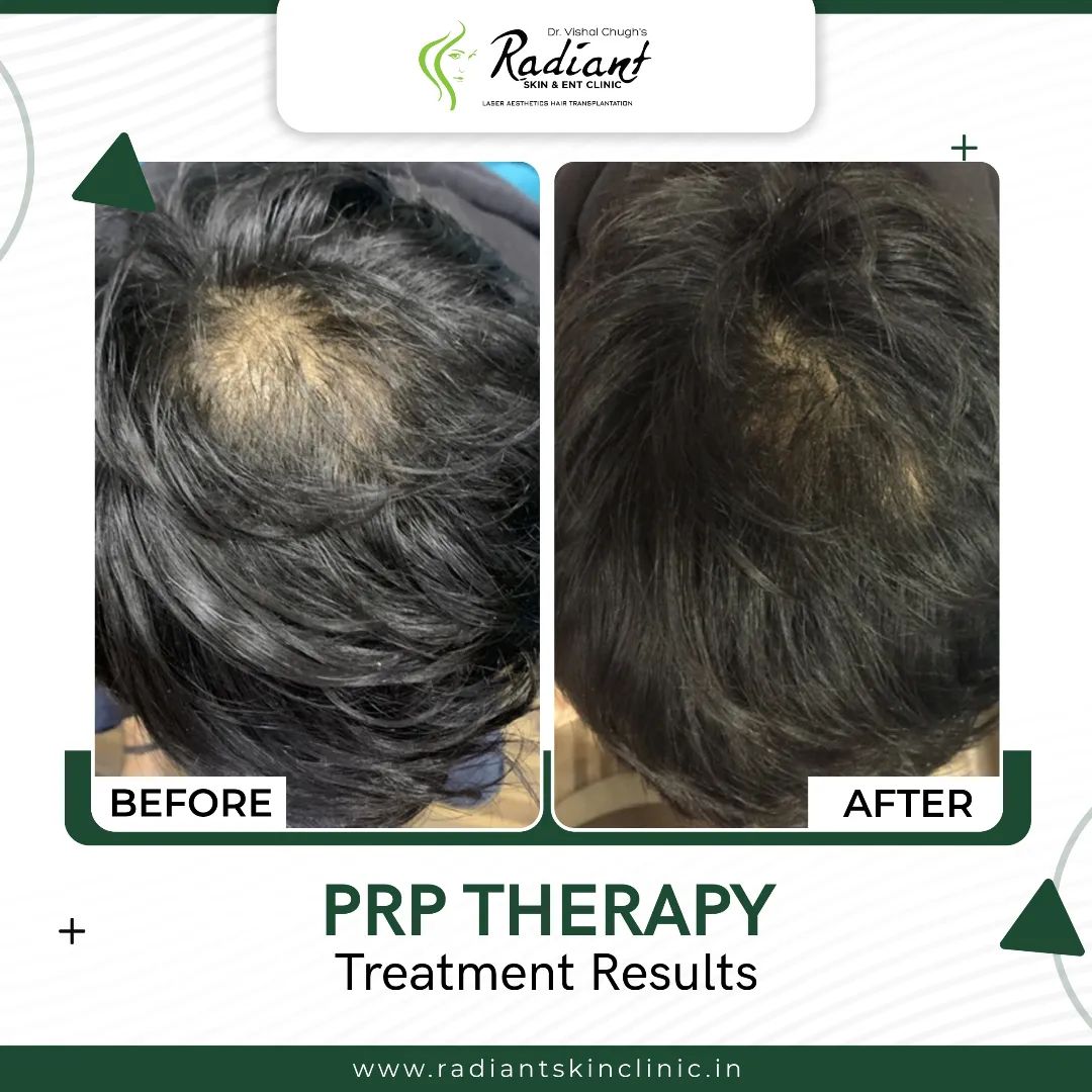 Best PRP Therapy Treatment in Jaipur