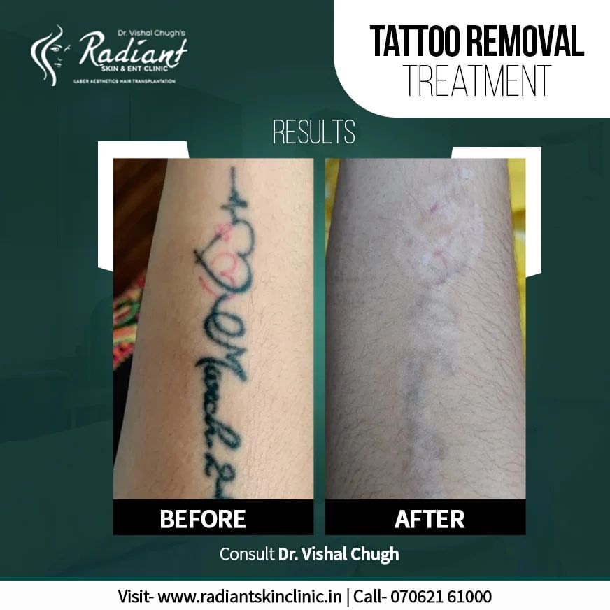 Best Tattoo Removal Clinic in Jaipur
