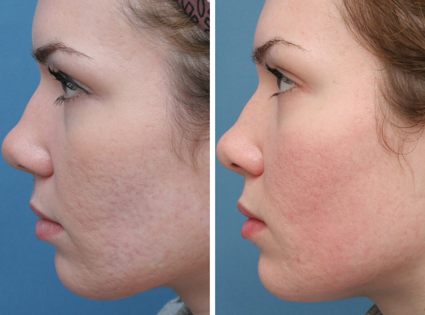 Acne Scar Treatment in Jaipur