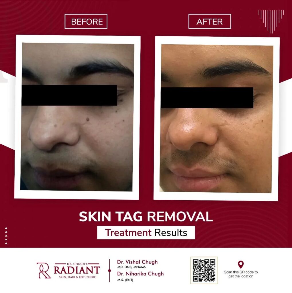 Skin Tags Treatment in Jaipur