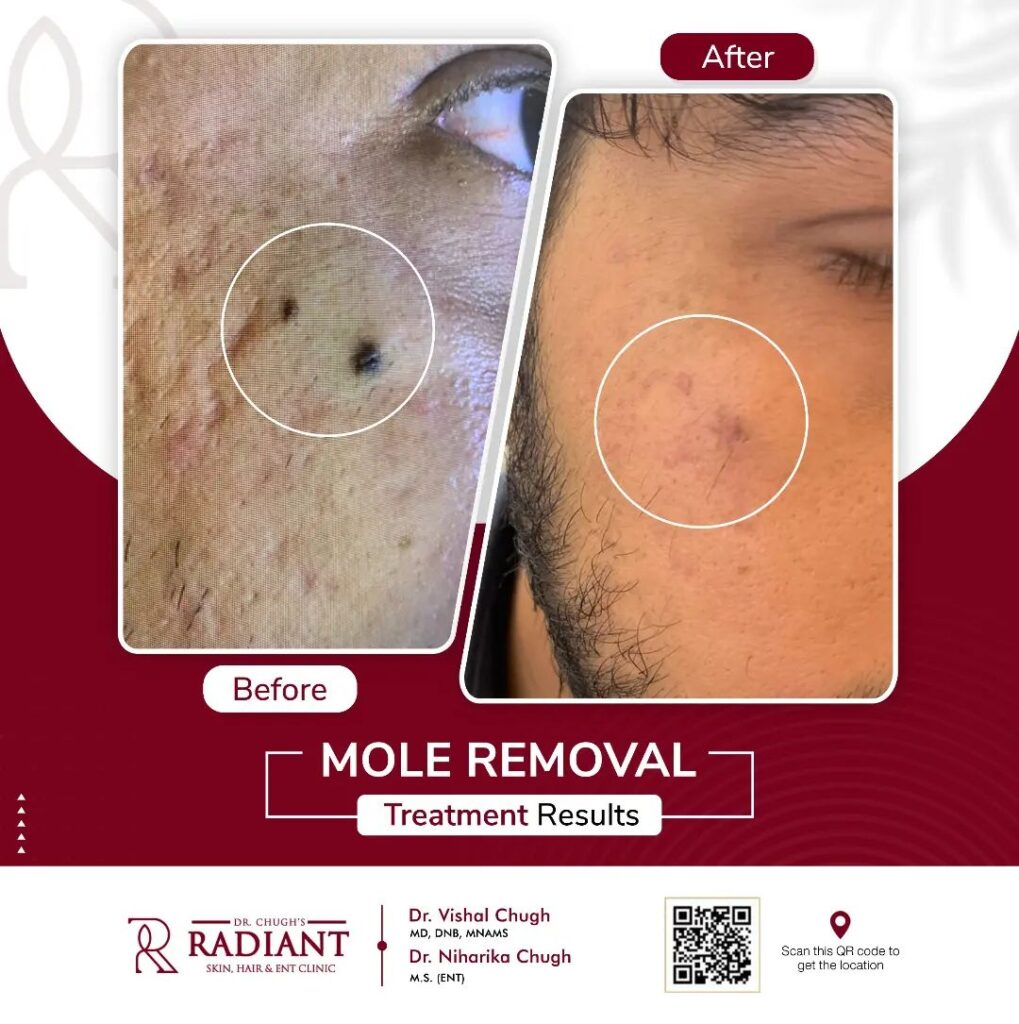 mole removal treatment! in jaipur