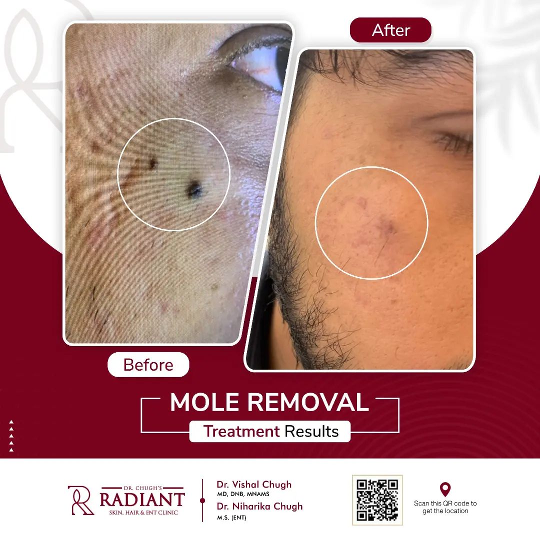 mole removal treatment! in jaipur