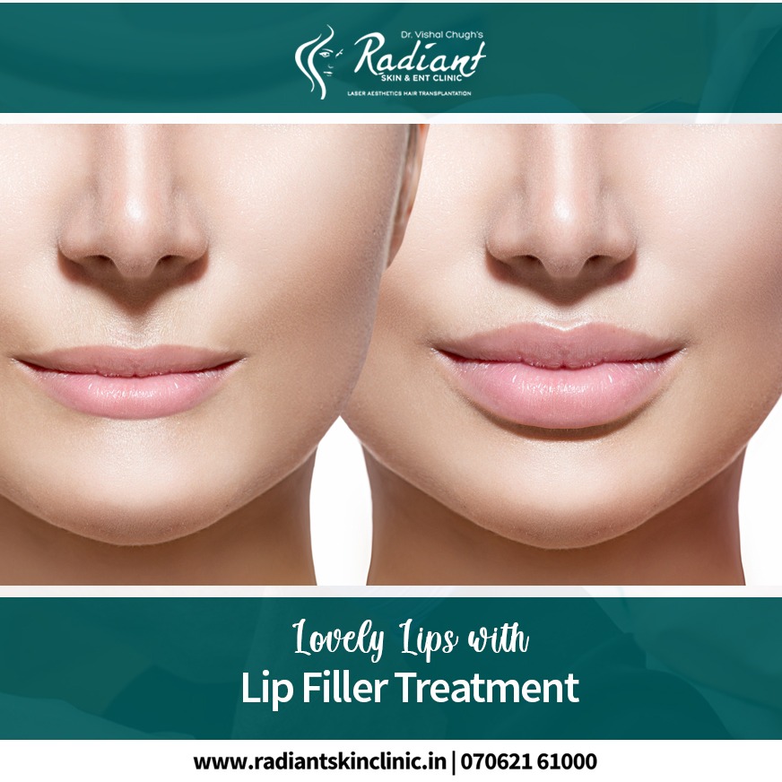 Everything You Need to Know About Lip Fillers in jaipur