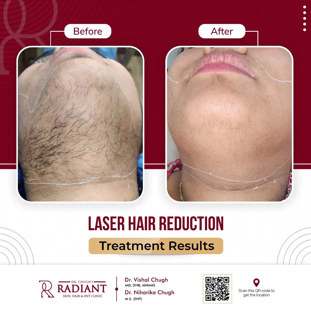 Laser Hair Removal Treatment in Jaipur