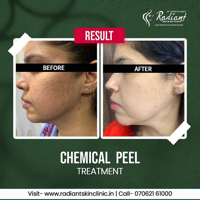 chemical peeling treatment in jaipur