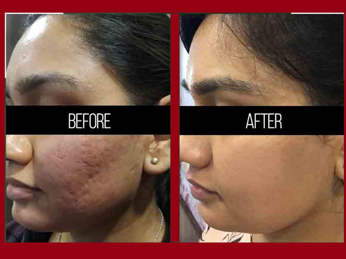 Chemical Peeling Treatment in Jaipur Best Doctors For Chemical Peels Treatment In Jaipur Chemical Peel Treatment in Jaipur Best Chemical Peel Treatment in Jaipur Chemical Peel Treatment In Jaipur Chemical peelings Treatment in Jaipur Chemical Peeling in Jaipur Chemical peels in Jaipur Best Chemical Peel Doctors In Jaipur Chemical Peels Doctors in Jaipur