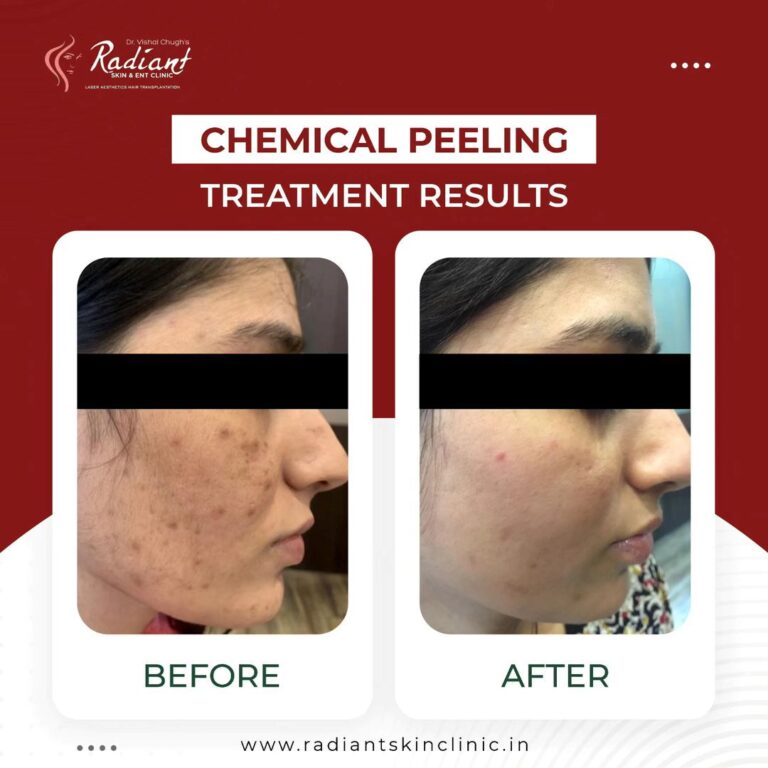 Best Chemical Peel Treatment Jaipur