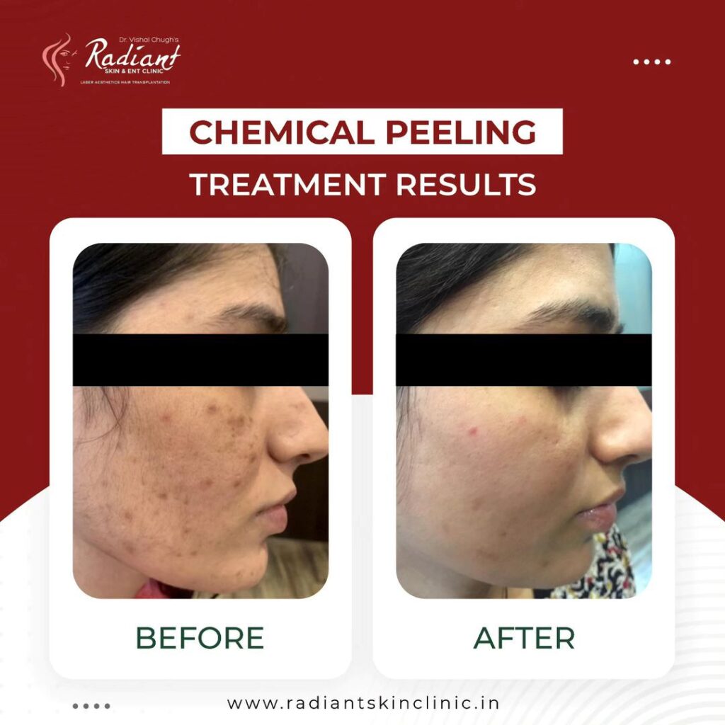 Chemical Peeling Treatment in Jaipur Best Doctors For Chemical Peels Treatment In Jaipur Chemical Peel Treatment in Jaipur Best Chemical Peel Treatment in Jaipur Chemical Peel Treatment In Jaipur Chemical peelings Treatment in Jaipur Chemical Peeling in Jaipur Chemical peels in Jaipur Best Chemical Peel Doctors In Jaipur Chemical Peels Doctors in Jaipur