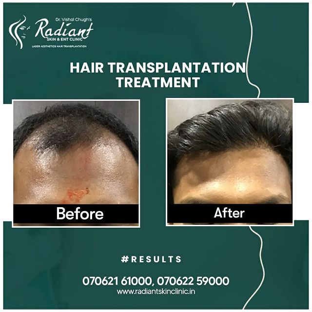 Best Hair Transplant Doctor in Jaipur