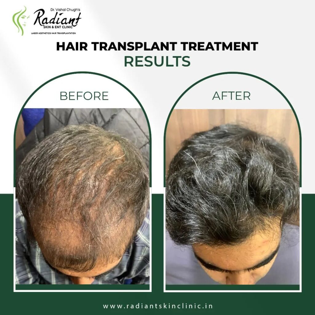 hair transplant doctors in Jaipur