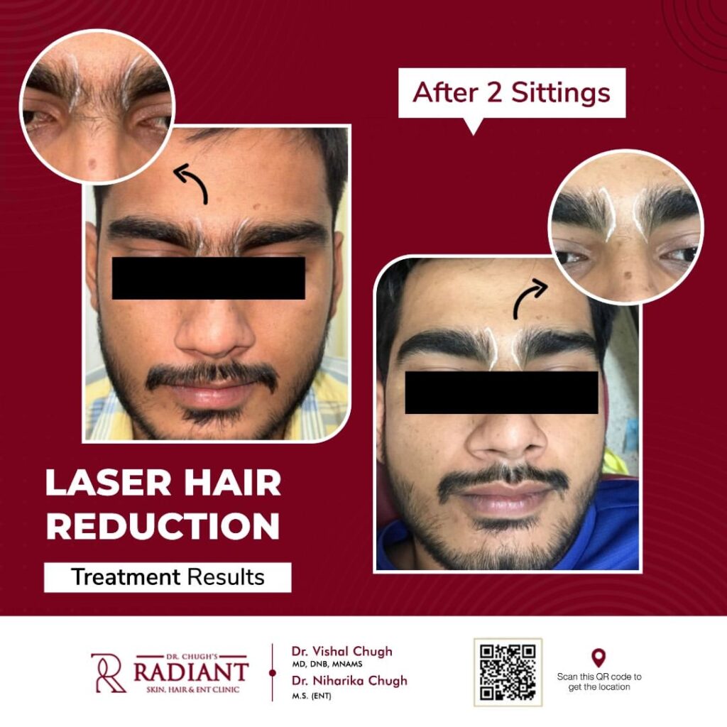 Laser Hair Removal Doctors in Jaipur