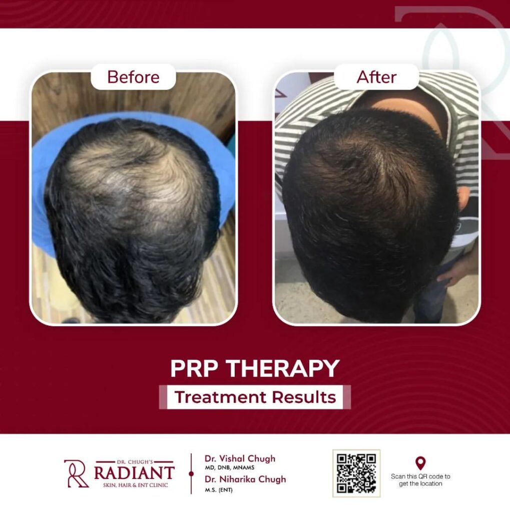 Best clinic for Alopecia treatment in Jaipur