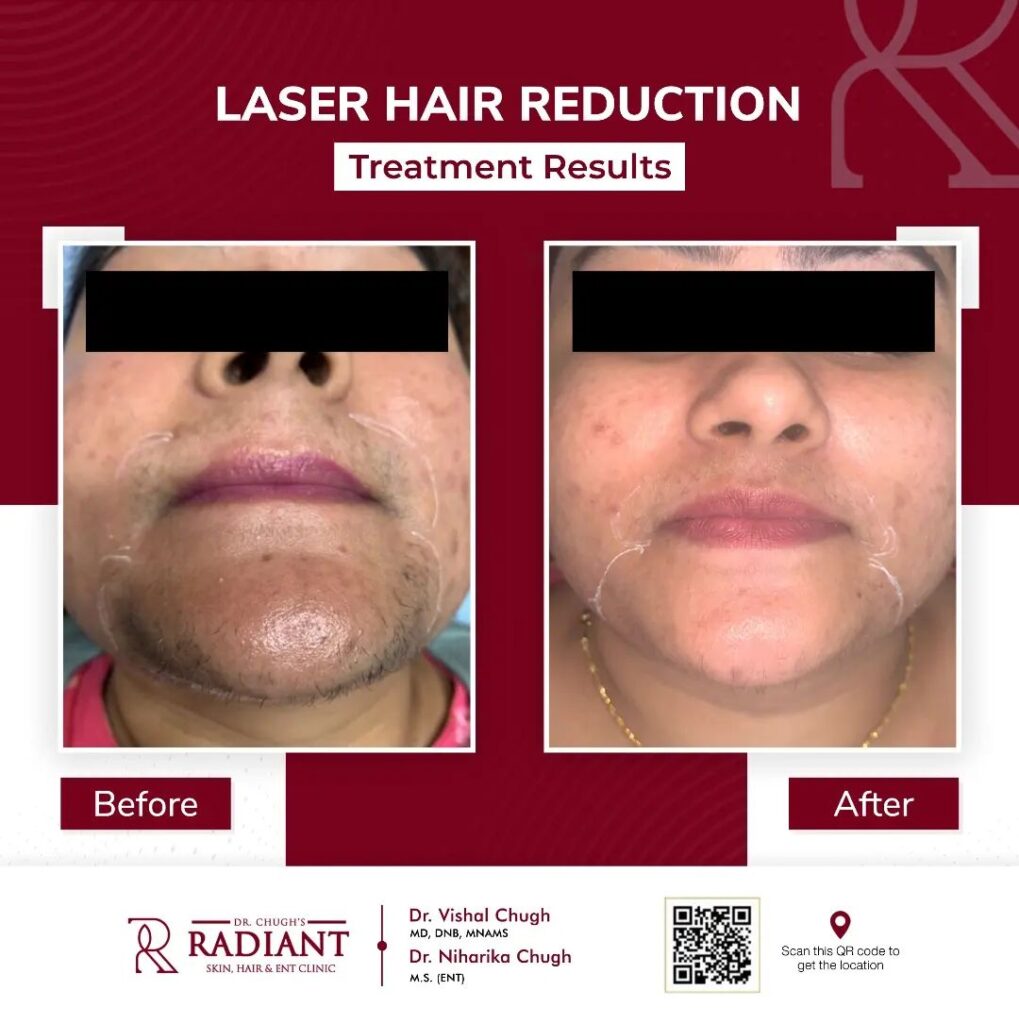 Laser Hair Removal in Malviya Nagar, Jaipur