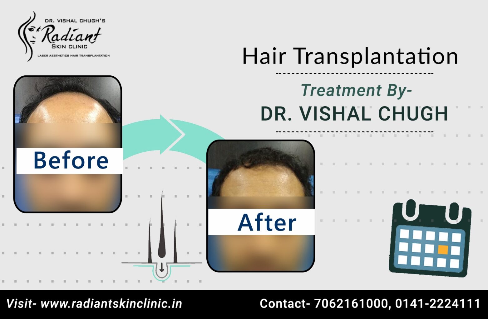 hair transplant doctors in Jaipur