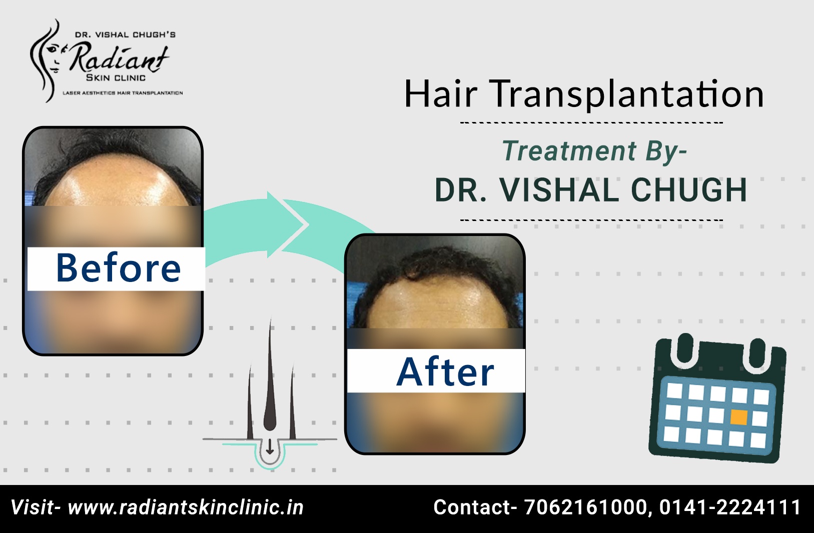 Best Hair Transplant Clinic in Jaipur