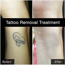 permanent tattoo removal doctors in Jaipur.