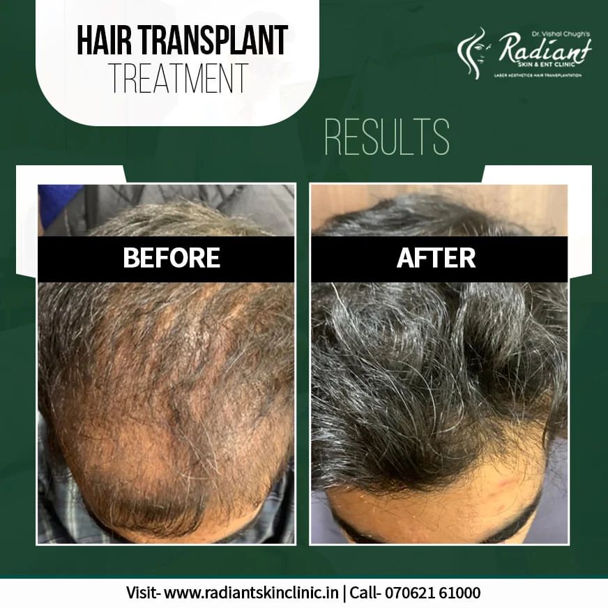 Hair Transplant Doctors in Jaipur