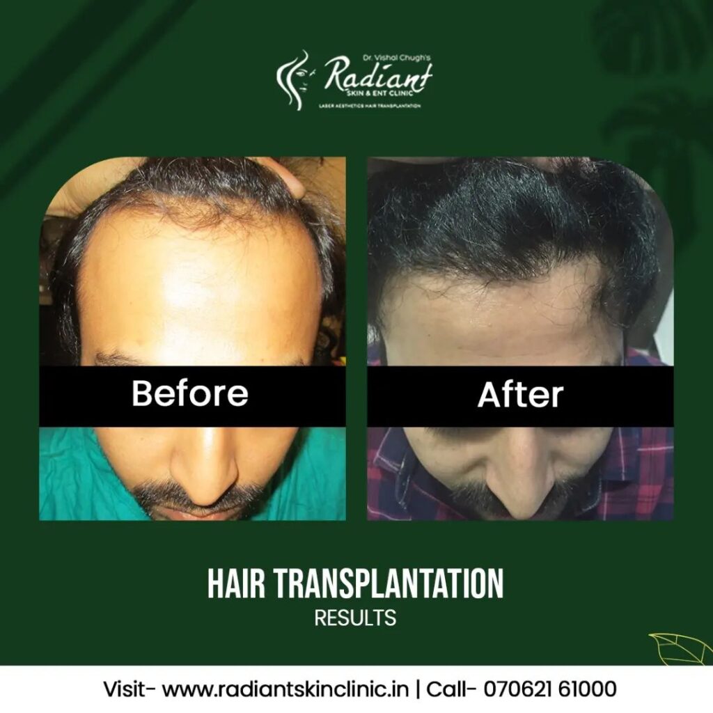 Best Hair Transplant in Jaipur