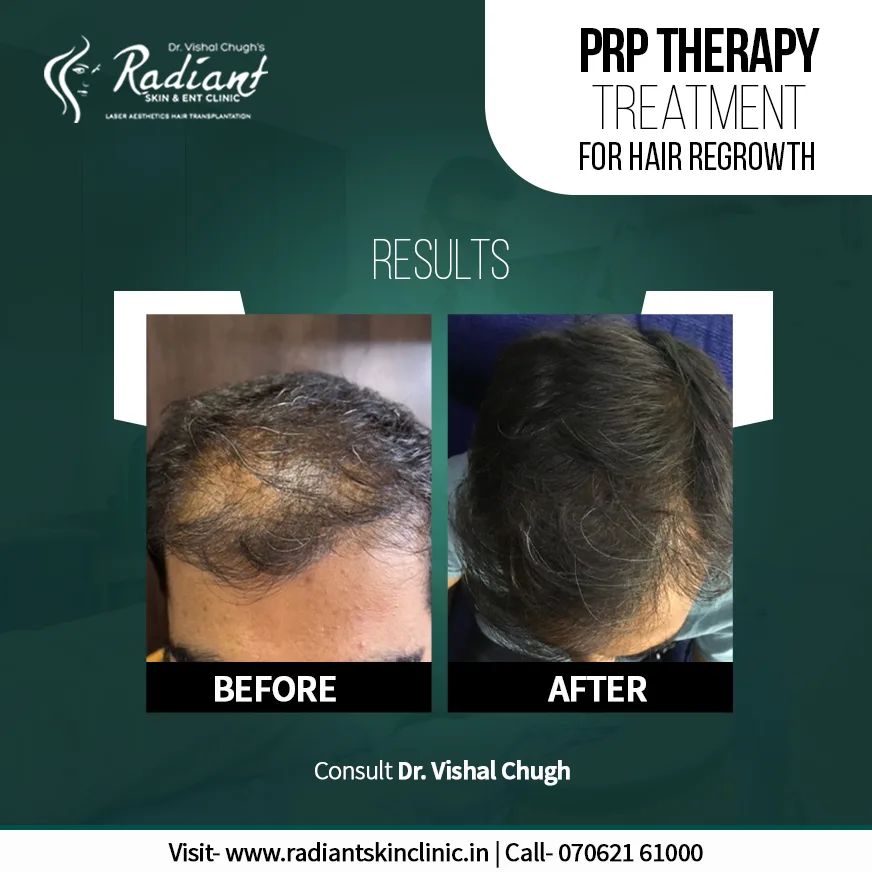 Best Hair Transplant Cost in Jaipur