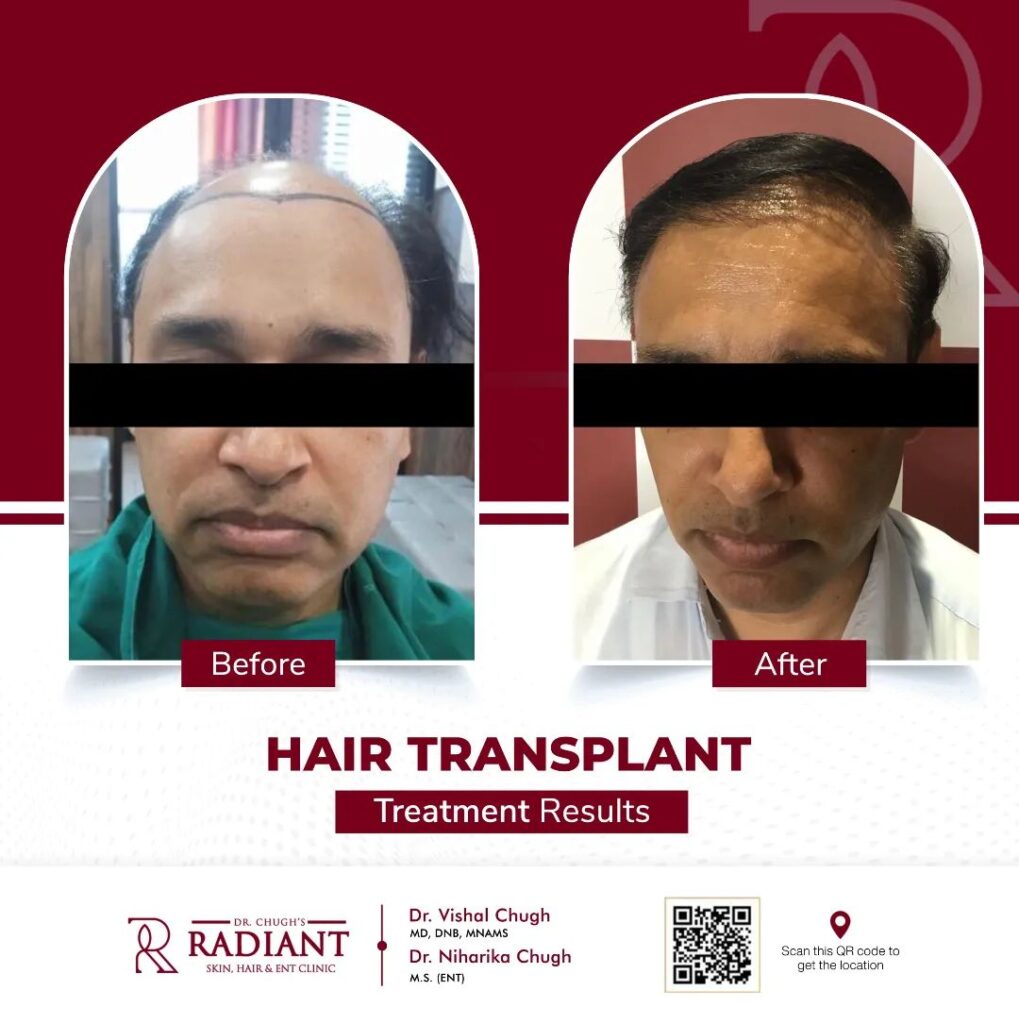 Best Hair Transplant Clinic in Jaipur