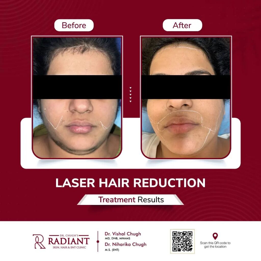 Laser Hair Removal in Jaipur