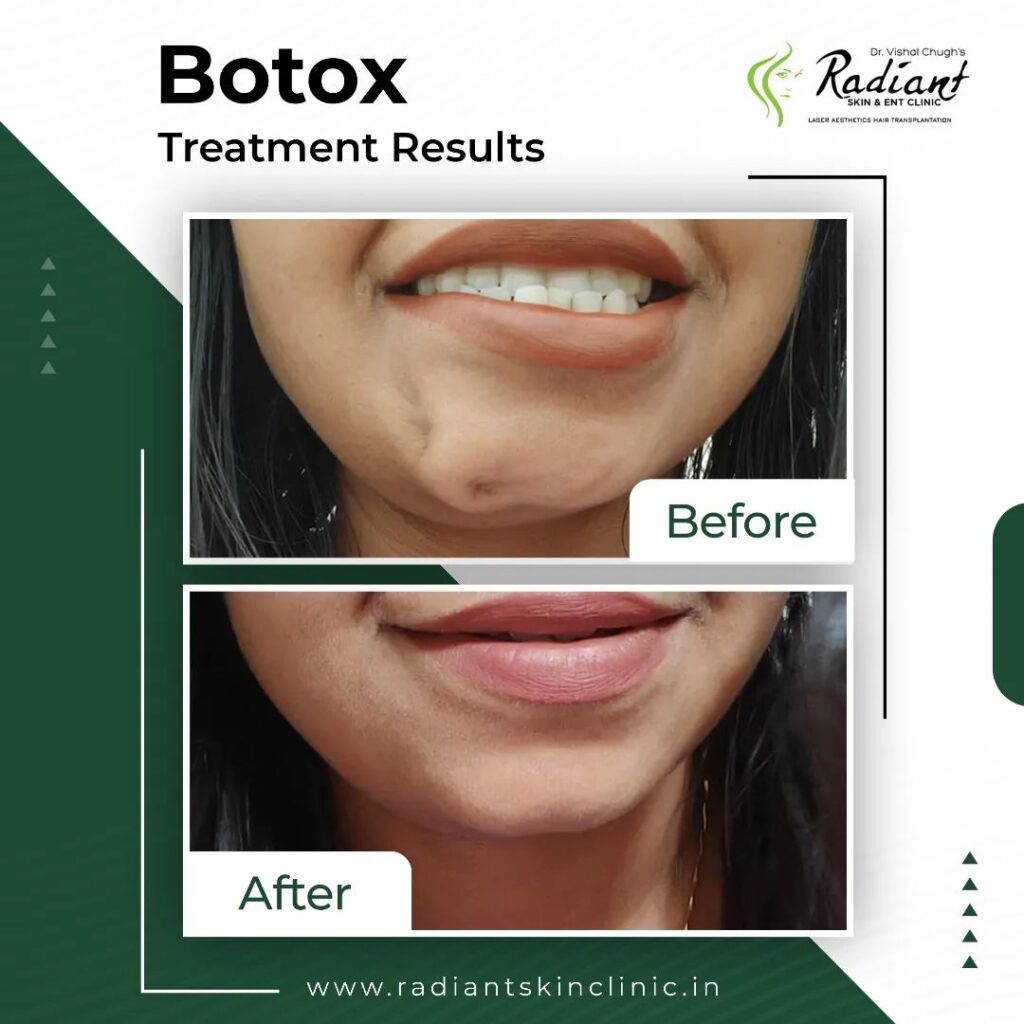 Best Botox Treatment in Jaipur