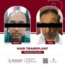 Best Hair Transplant Cost in Jaipur