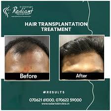 Best Hair Transplant Cost in Jaipur