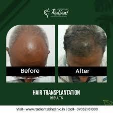 Hair Transplants Doctors In Jaipur