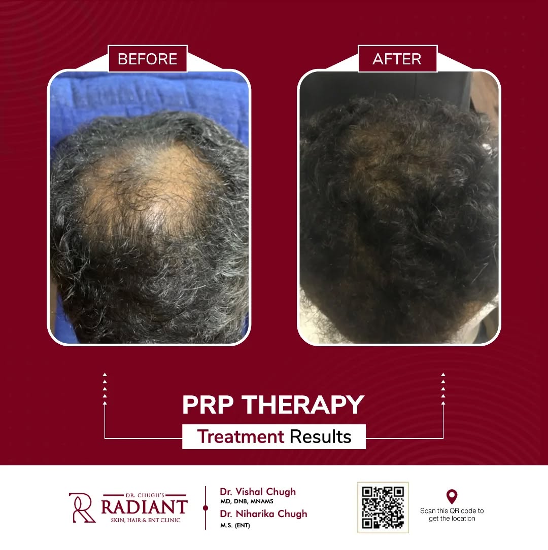 PRP Treatment in Jaipur