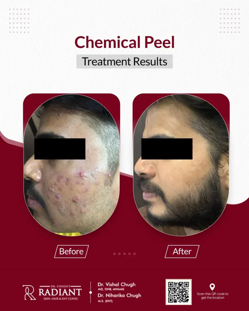 Facial Rejuvenation Treatment in Jaipur