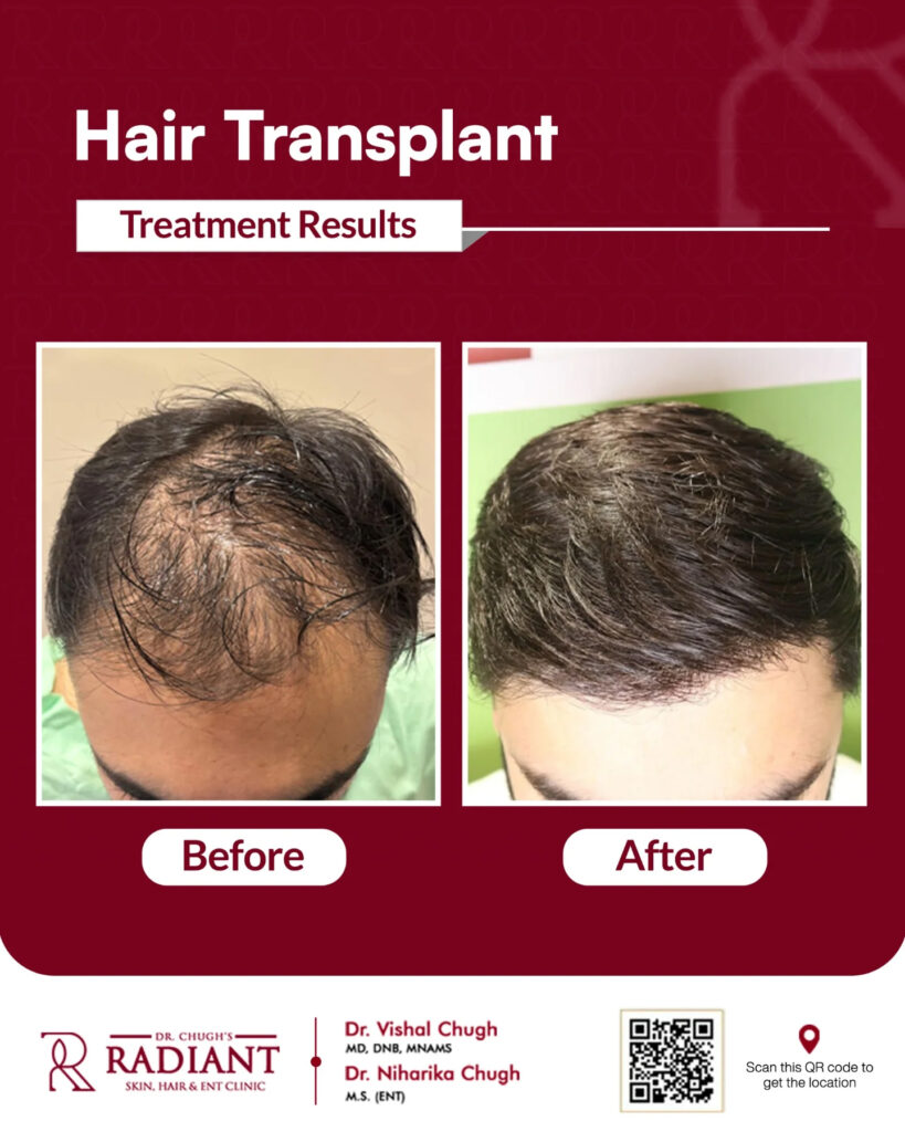 Hair Transplants Doctor in Jaipur