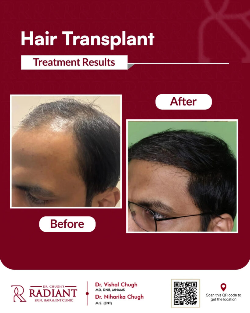 Natural Hair Transplant in Jaipur 