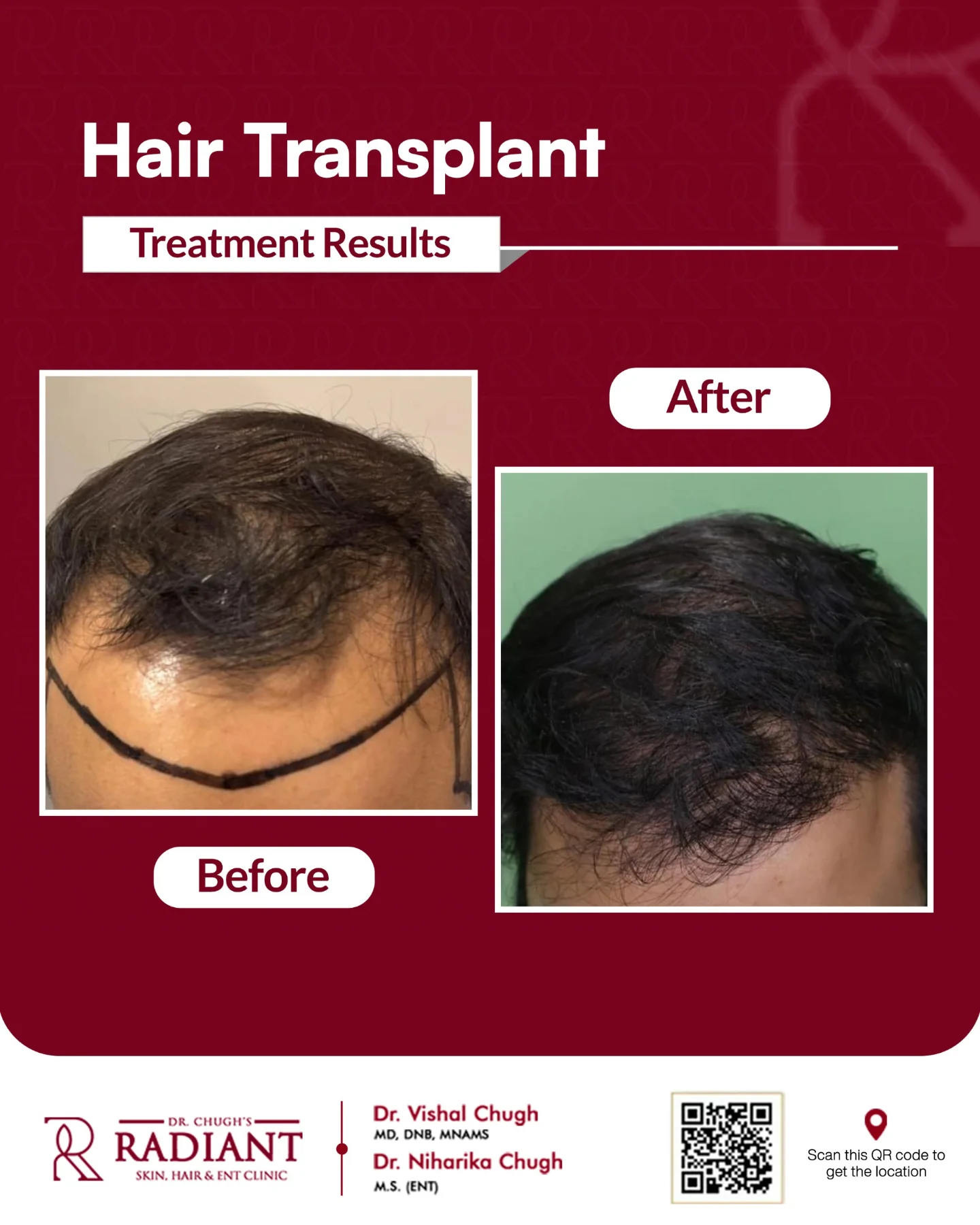 Hair Transplant in Jaipur