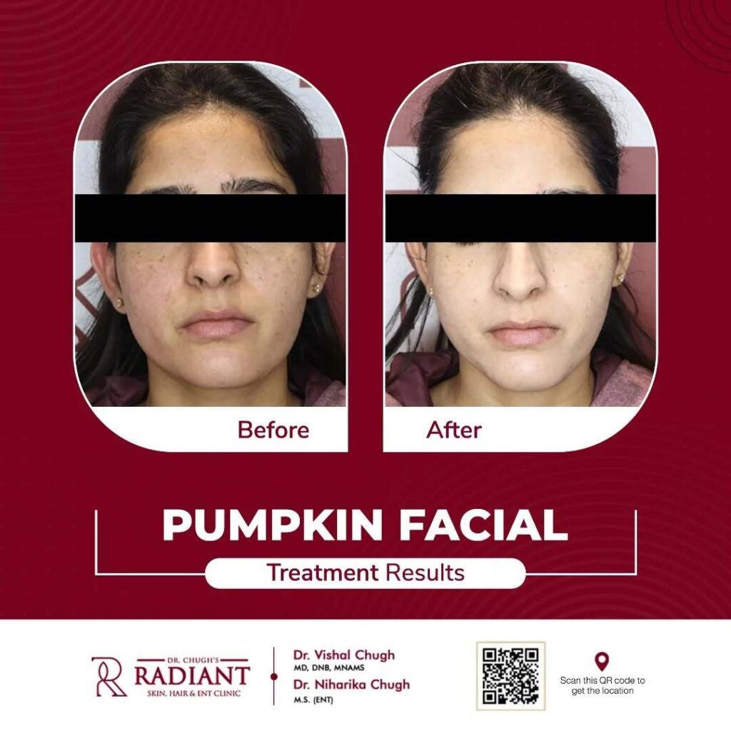 Pumpkin Peel Treatment in Jaipur