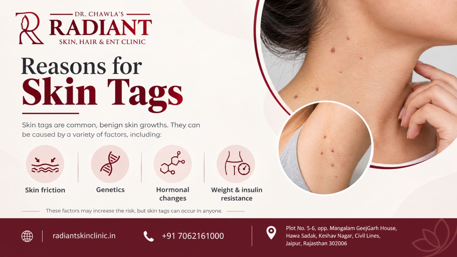 Reason for Skin Tags